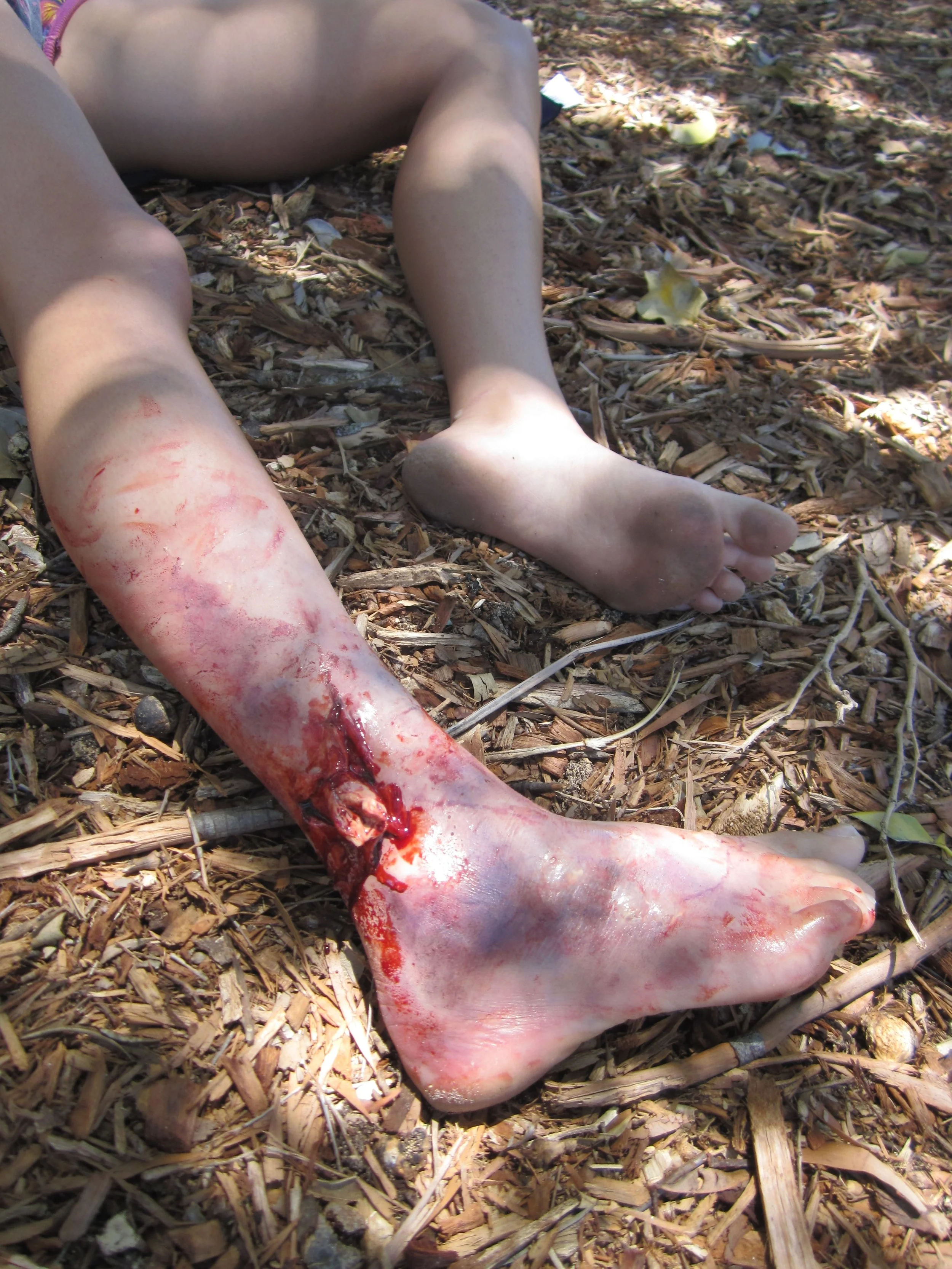 compound fracture