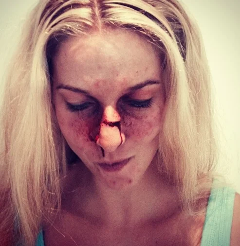 Broken nose using wax
