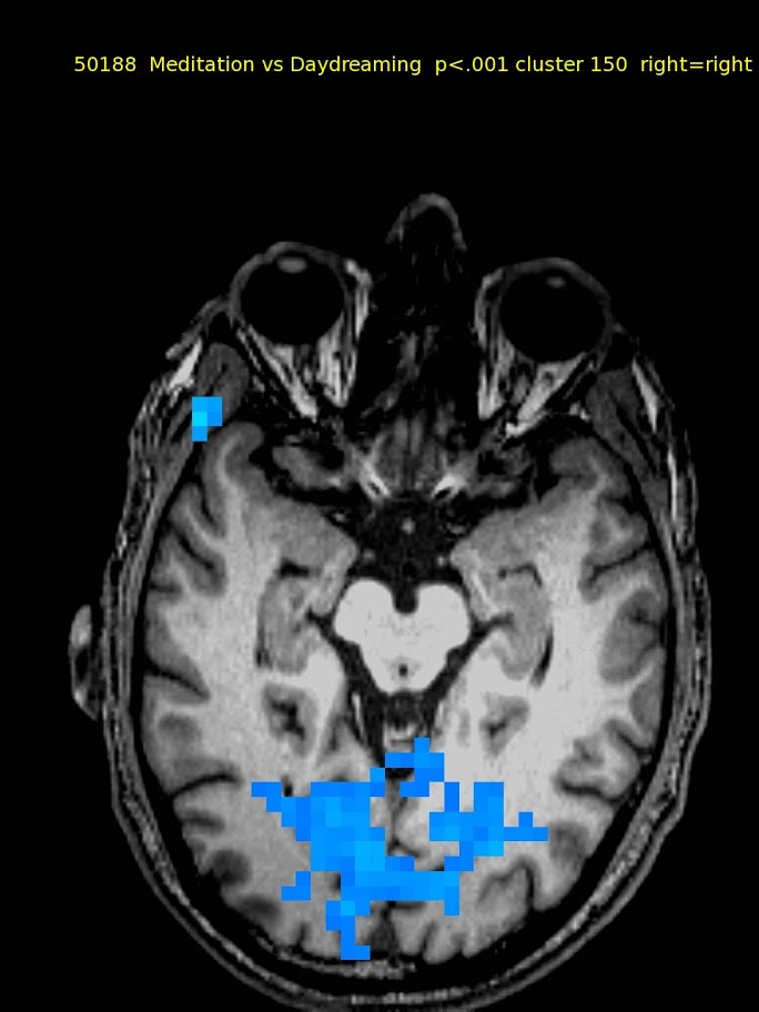 61 yo male, TM meditator since 1970. No activations.  Deactivation in visual cortex only.