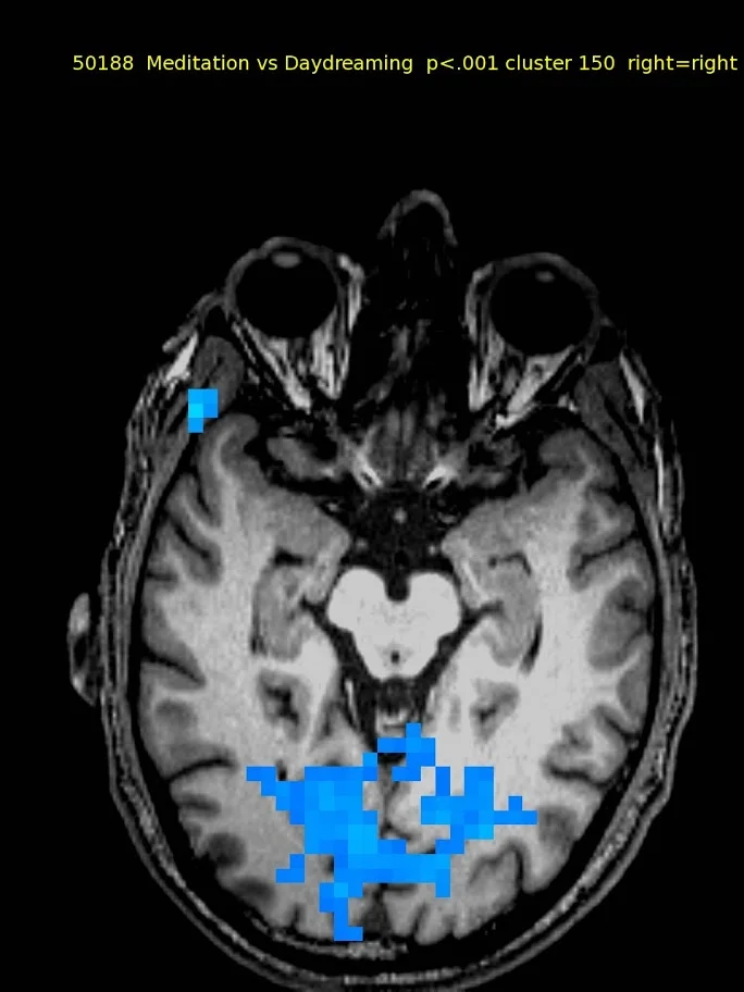 61 yo male, TM meditator since 1970. No activations. Deactivation in visual cortex only.