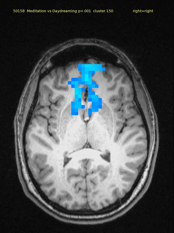 23 yr old male, taught meditation in school class and practices intermittently. Deactivation in medial frontal cortex. 