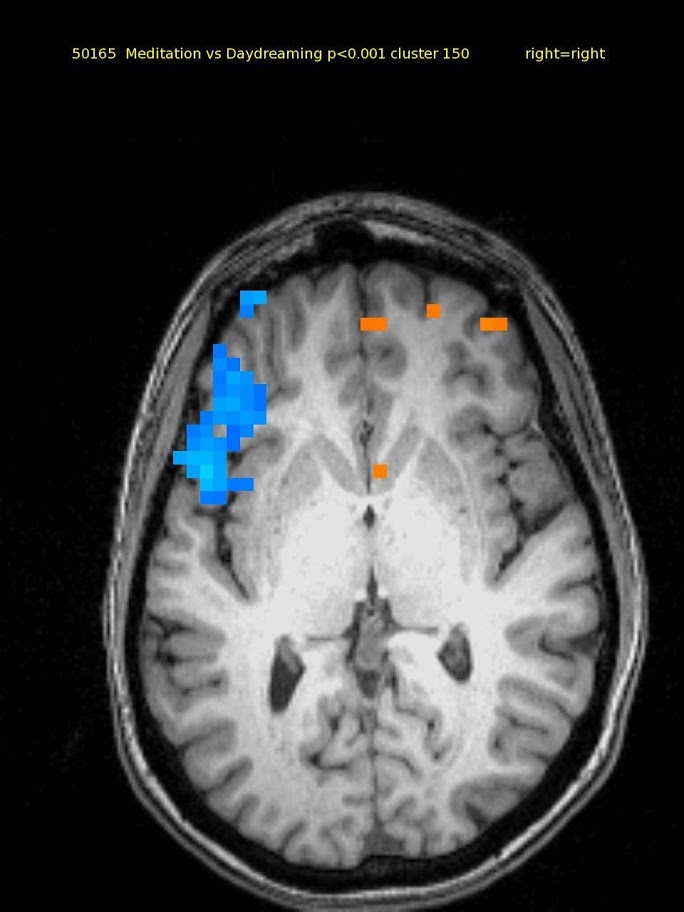 60 yr old female TM meditator since 1970. Mid-level axial slice shows deactivation in left lateral frontal cortex