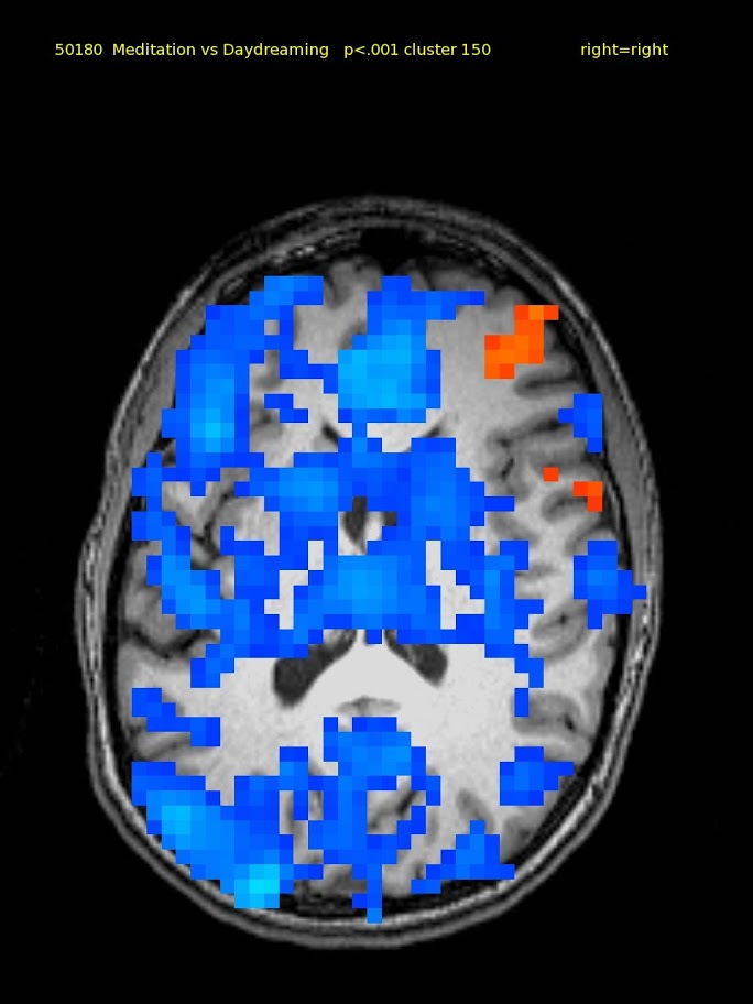 60 yr old female TM meditator since 1970. Mid-level axial slice shows deactivation in left lateral frontal cortex