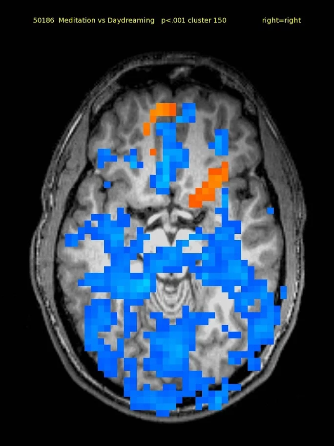 7 yo male TM meditator for one month. Activations in left orbital and right inferior lateral frontal and left superior parietal cortex. Deactivations widespread.