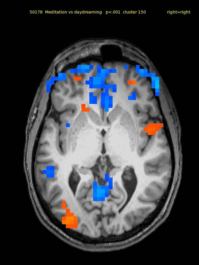 24 yo m novice. Activations: bilateral superior parietal, & lateral front., right inferior front., right insula, & left temporal cortex. Deactivations: bilateral medial front. & ant., post. cingulate.