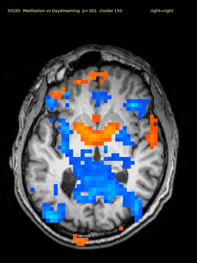 61 yo male TM meditator since 1973. Activations in bilateral orbital and ventral medial frontal cortex and thalamus. Deactivations were widespread