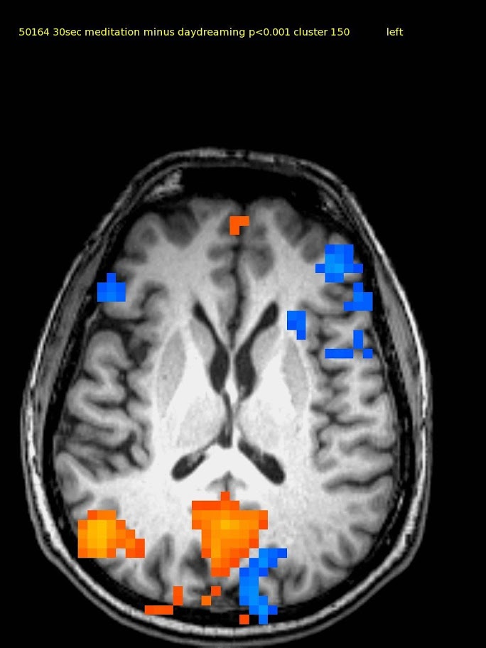 64 yr old male TM meditator since 1970. Activations in medial frontal, right parietal and posterior cingulate cortex. Deactivations in bilateral inferior lateral frontal cortex.