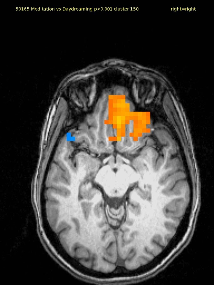 60 yr old female TM meditator since 1970. Activation in right ventral medial prefrontal cortex