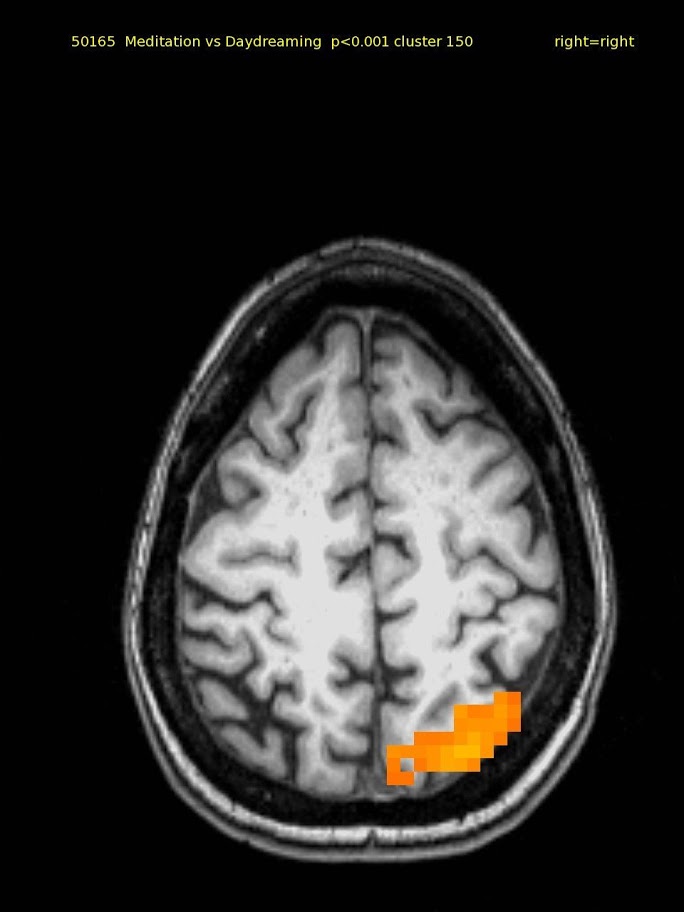 60 yr old female TM meditator since 1970. High axial slice shows activation in right superior parietal cortex.