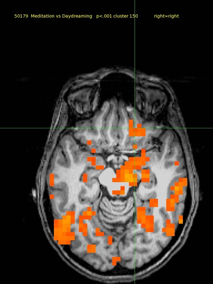 43 yo female, experienced.  TM meditator since 1974. Activations widespread including amygdala.  Deactivations none.