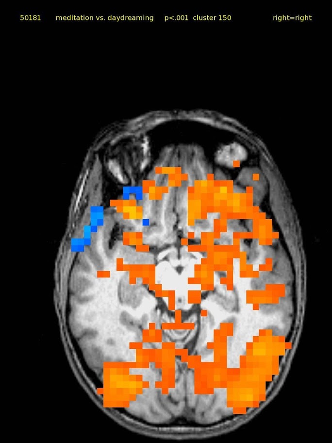 47 yo female. TM since 1971, consistent.  Activations diffuse except visual, and cingulate cortex.  Subject stated she was having trouble breathing during scanning.