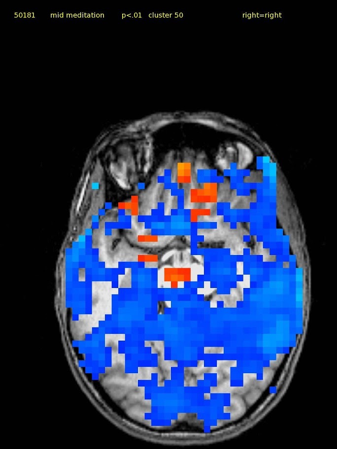 47 yo female TM meditator since 1971, consistent. Activations in orbital and ventral medial prefrontal cortex. Deactivations widespread. Subject stated she was having trouble breathing during scan.