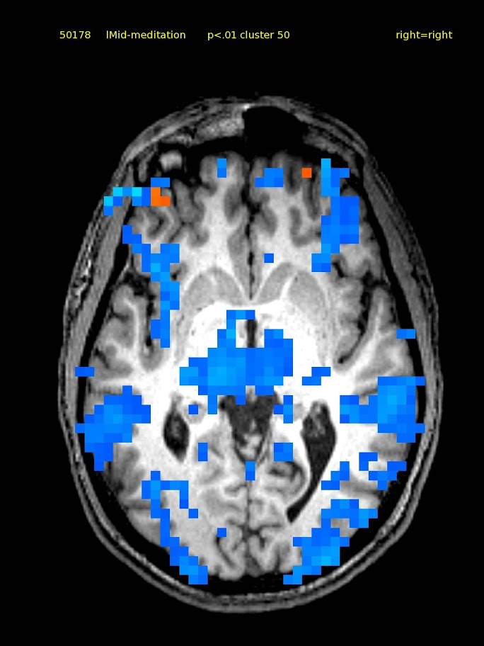 24 yo male, self-taught since 2007 intermittent.  Activations in bilateral superior lateral frontal cortex. Deactivations widespread.