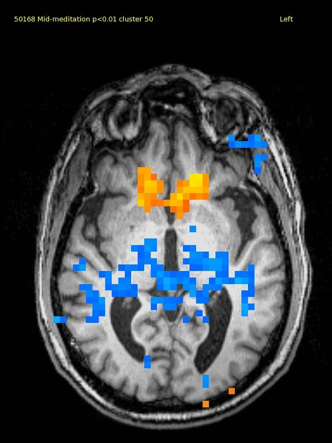 61 yr old male, experienced TM meditator since 1971. This axial slice shows activation in the ventral medial prefrontal cortex and deactivation in the thalamus and adjacent areas.