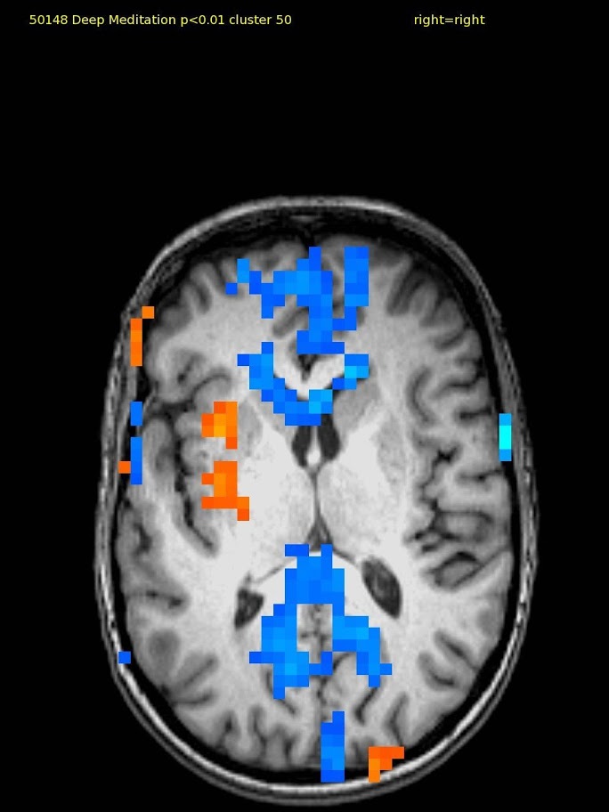 58 yr old female, experienced. TM meditator since 1971. Deactivation in ventral medial prefrontal and post. cingulate cortex and activation in left insula.