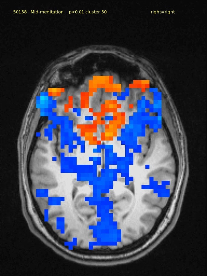 64 yr old male, experienced TM meditator since 1970.  Axial slice shows a small amount of activation in medial frontal lobe and deactivation in bilateral parietal and post cingulate cortex