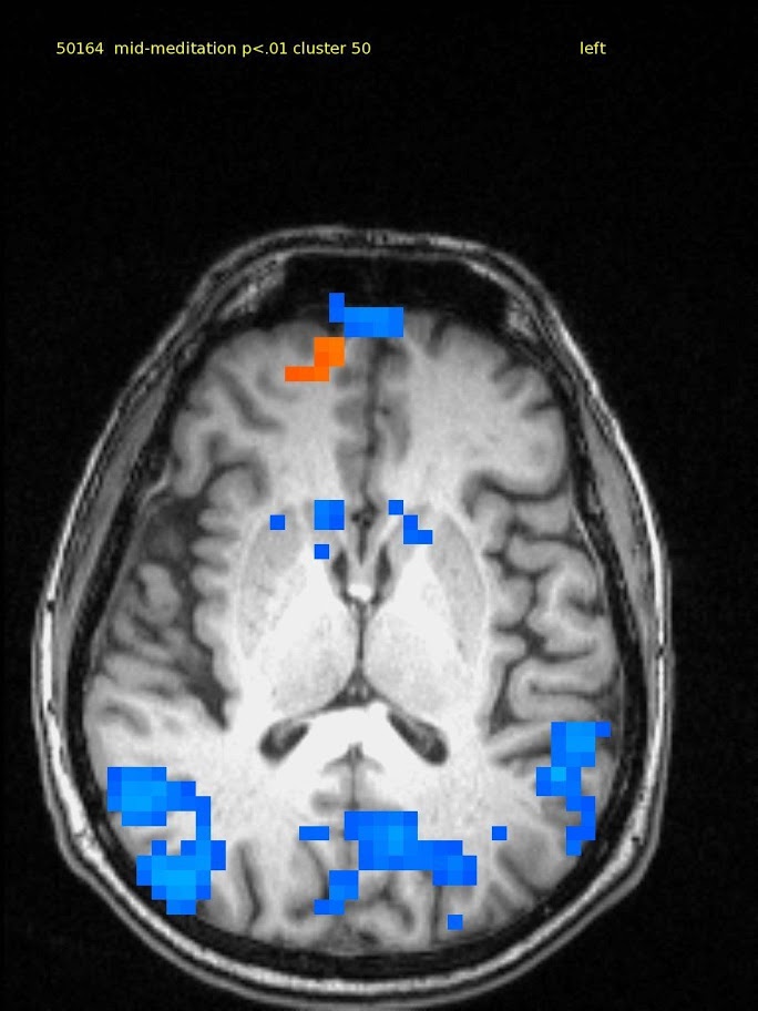 64 yr old male, experienced TM meditator since 1970.  Axial slice shows a small amount of activation in medial frontal lobe and deactivation in bilateral parietal and post cingulate cortex