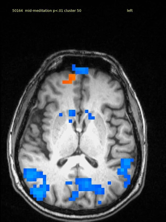 64 yr old male, experienced TM meditator since 1970. Axial slice shows a small amount of activation in medial frontal lobe and deactivation in bilateral parietal and post cingulate cortex