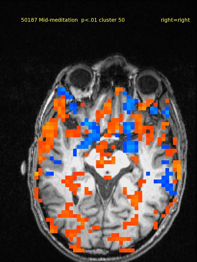 61yo male, TM meditator since 1970. Activations in ventral medial prefrontal, but also widespread.  Deactivations in bilateral thalamus.