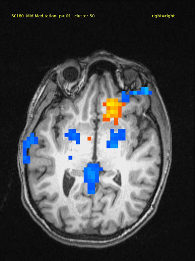 29 yo female novice. TM meditator since 11/2008. Activation localized to right ventral medial prefrontal cortex. Deactivations seen in thalamus, post. cingulate, auditory & frontal cortex bilaterally.