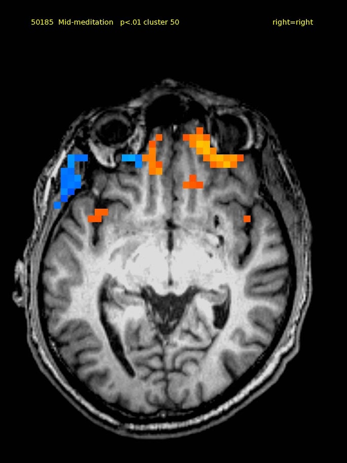 61 yo male TM meditator since 1973.  Activations in bilateral inferior lateral and orbital frontal cortex. Deactivations were not significant.