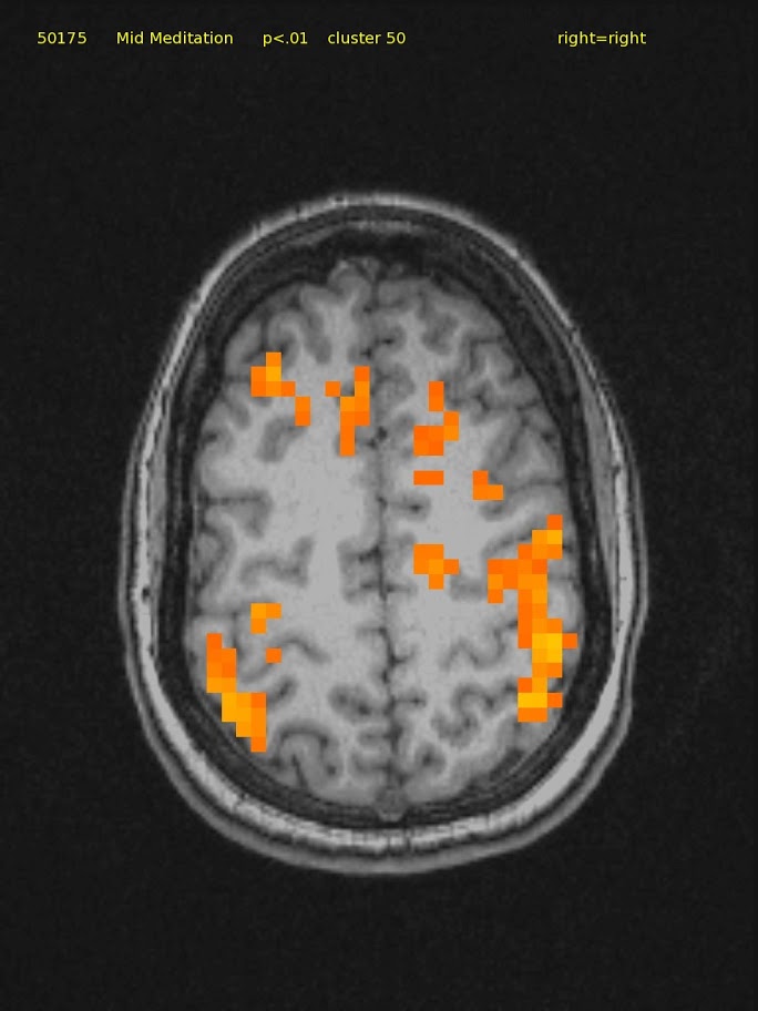 23 yr/o female, novice. TM Meditator since April, 2008. High axial slice shows bilateral parietal activation; auditory cortex is silent.