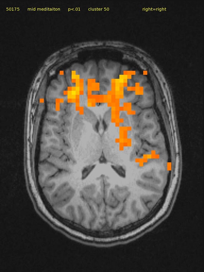 23 yr/o female, novice.  TM Meditator since April 2008. Axial slice shows bilateral frontal, right thalamic, and posterior insula activation