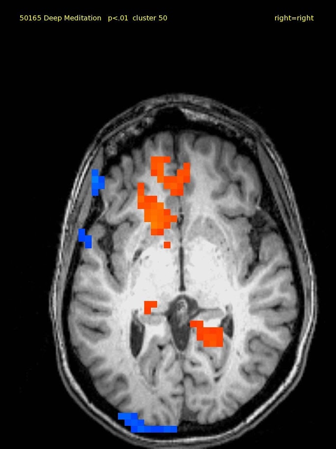 60 yr old female, experienced TM meditator since 1970.  The brain is very quiet except of activation in the ventral medial prefrontal cortex and also in the medial inferior temporal cortex.