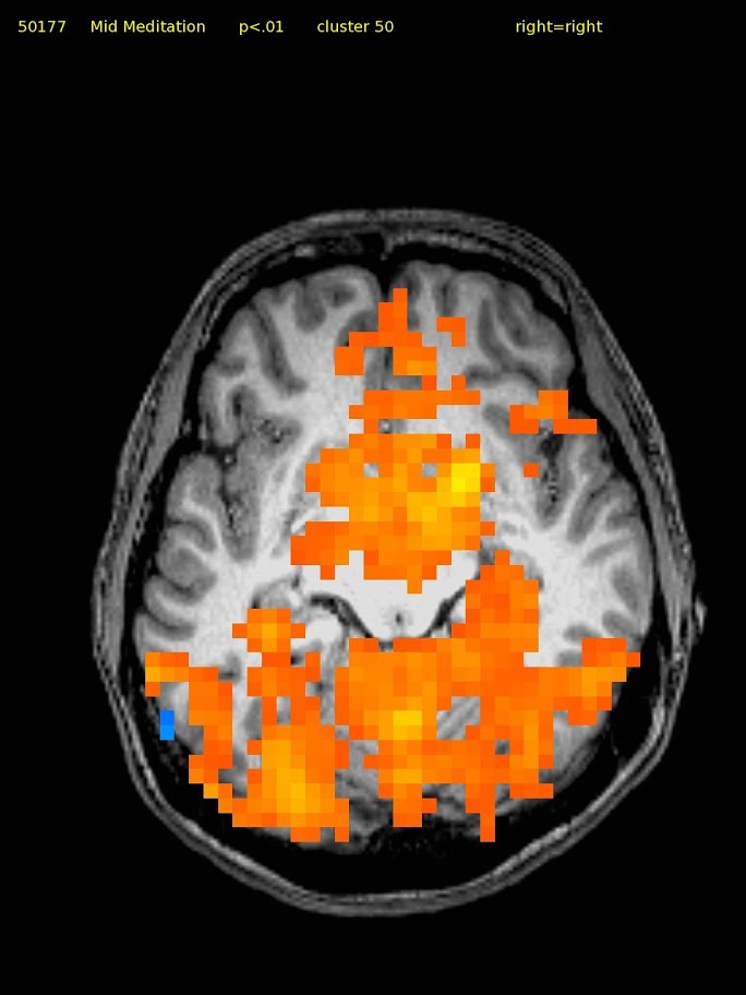 26 yr/o Female Novice TM Meditator. Widespread Activation.