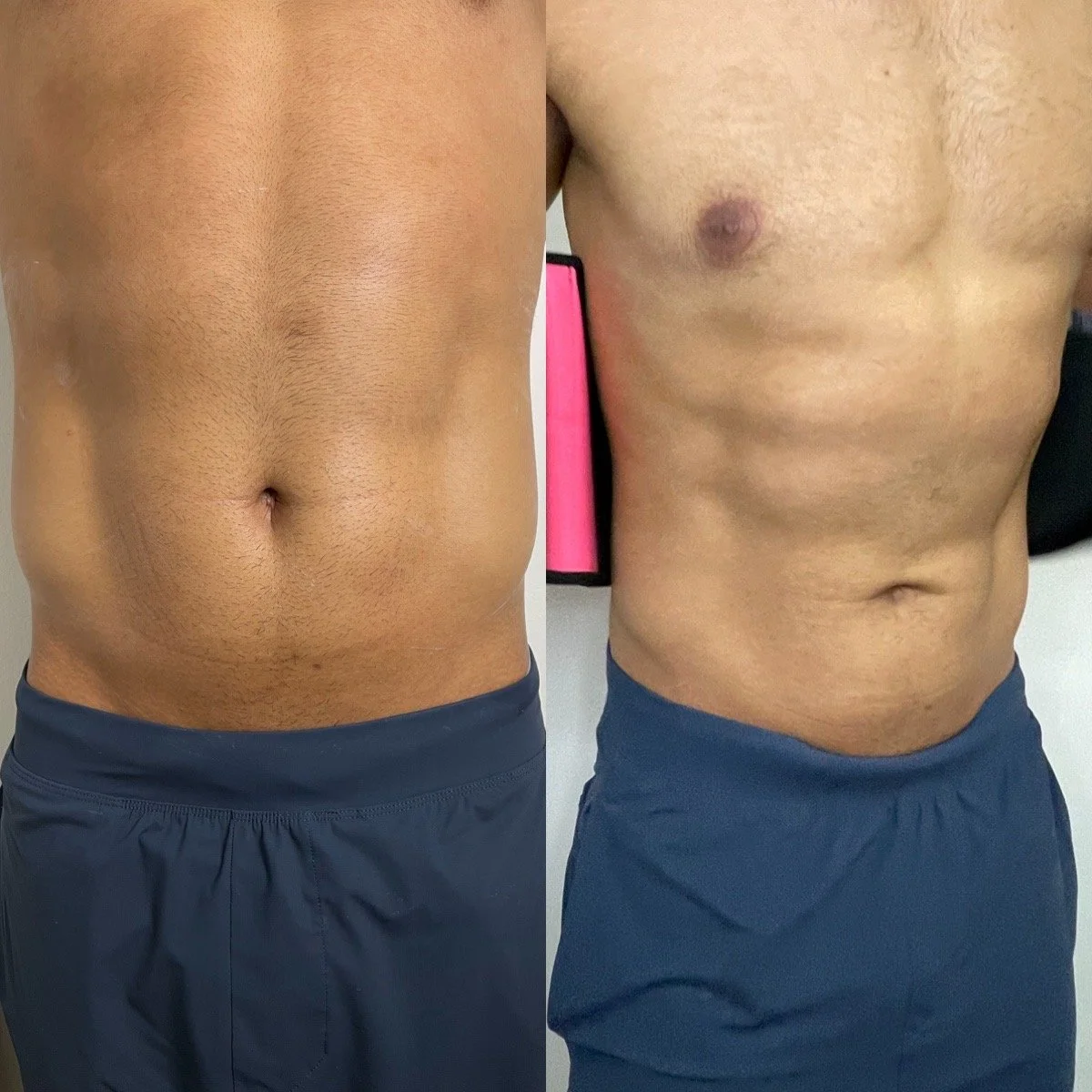 BAREHANDSPA Massage Therapy Skin Care Body Sculpting Laser — HI