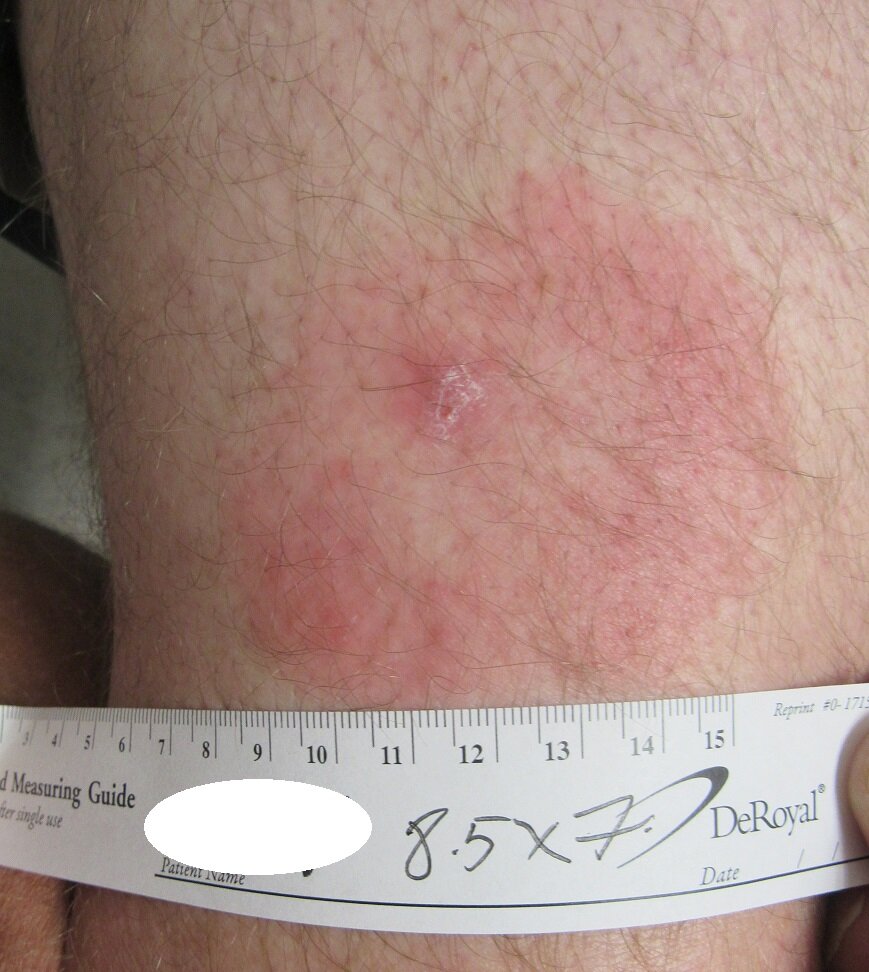 Lyme Disease Tick Bite Rash