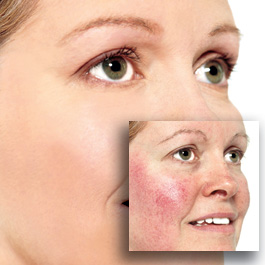 rosacea-before-after.jpg