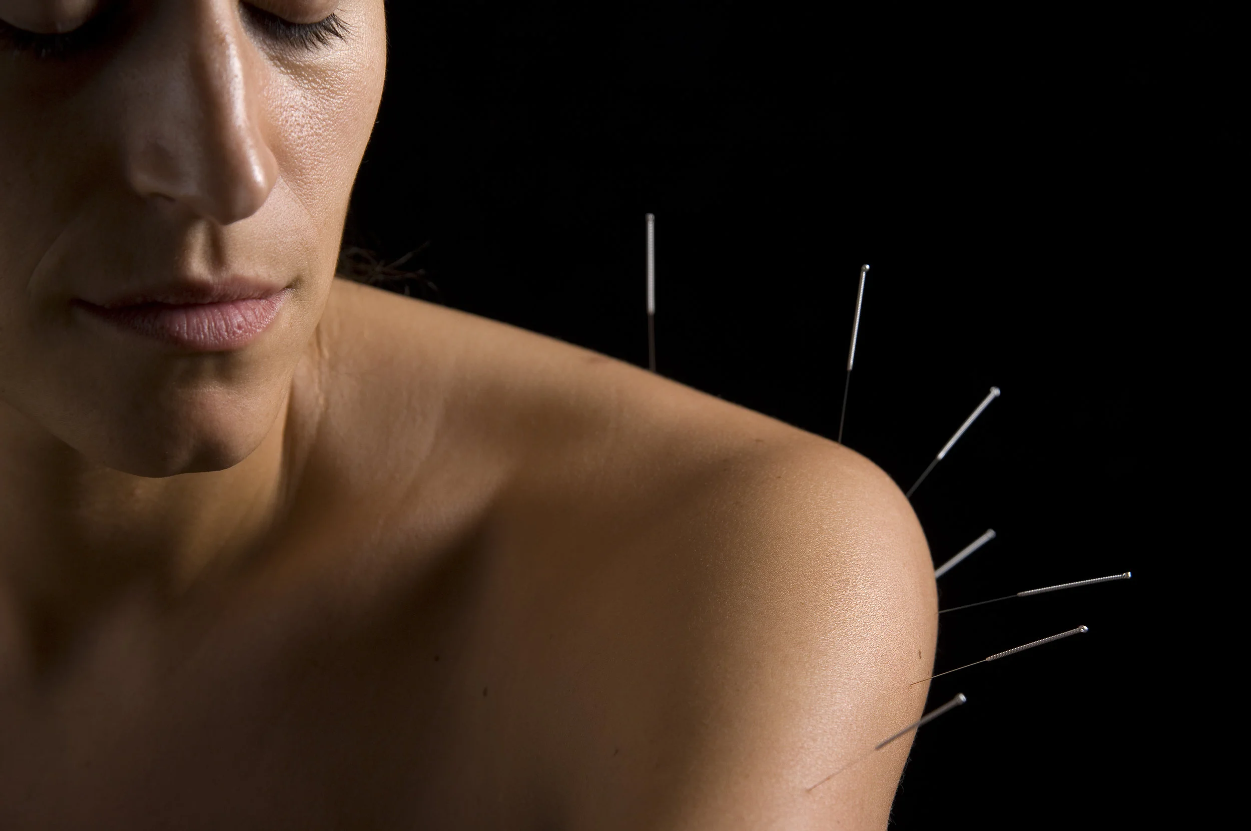 Acupuncture Restores Energy Flow Throughout the Body (Here's Why We Love It)