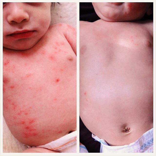 We just can't get over these before and after pics sent by @jillkfitness She said they would put Mom's Stuff Salve on twice a day and it totally cleared up their babe's eczema.