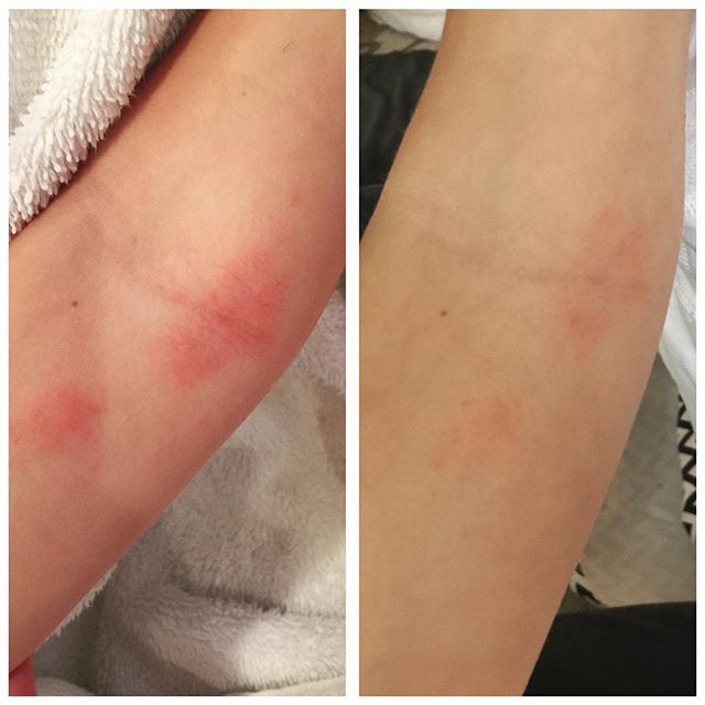Our friend @daniellebwilson sent this pic saying this is after two days of applying Mom's Stuff to her child's eczema patches. 