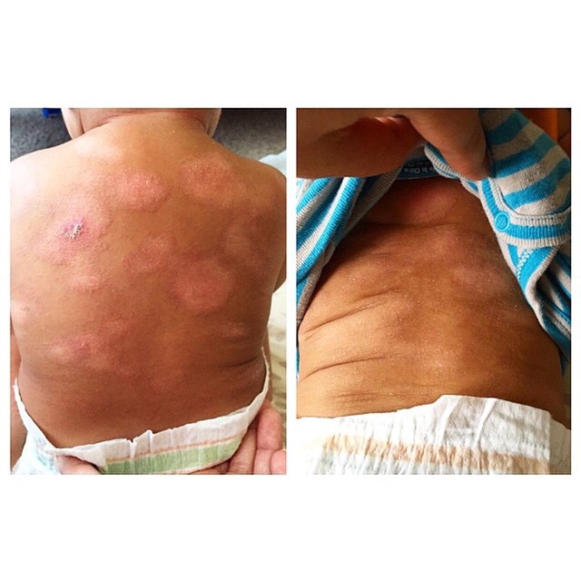" Mom's Stuff Salve is a miracle product. These patches showed up around the time my son turned 5 months. I’ve tried so many creams and ointments, and nothing worked. Until I found your Instagram account and knew I had to try. After only two weeks (vs. two months) the difference is night and day. I can finally breath a sigh of relief for my boy because I know that he's been relieved of the itchiness. Thank you, thank you for this amazing product!" - @saymadane