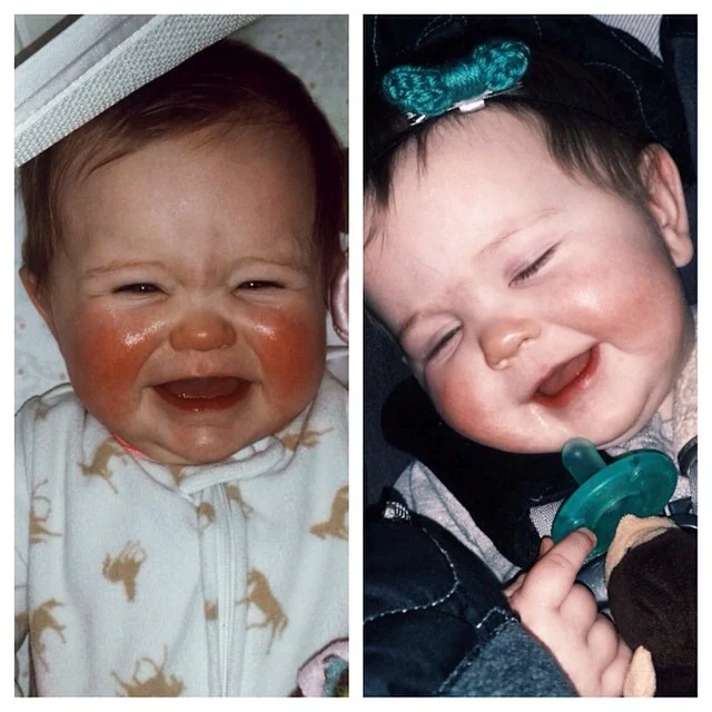 "Last night my baby's cheeks were super red and chapped. I had put lotion on while we were out and about but it wasn't doing anything. So right before I put her down I put Mom's Stuff Salve on them. The second picture is this morning right before we left for daycare so I had only used it once last night. Salve magic for my little girls cheeks! They are so much better this morning! I'm a believer!" -Elise, UT