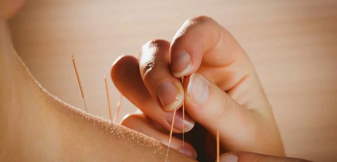 dry+needling+jenkins+physio+madeley.jpg