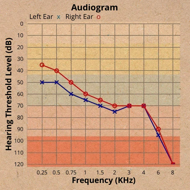 An audiogram showing severe loss of hearing in both the left and right ears
