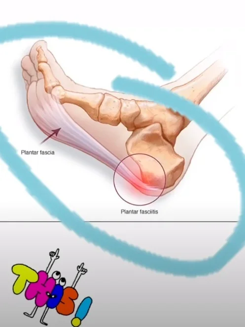 plantar-fasciitis-treatment-exercises.jpg