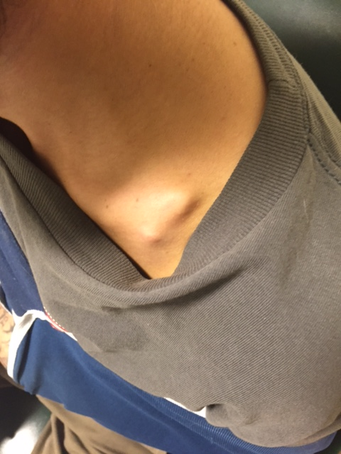 Figure 1: Physical exam showing displaced mid-clavicular fracture with skin tenting