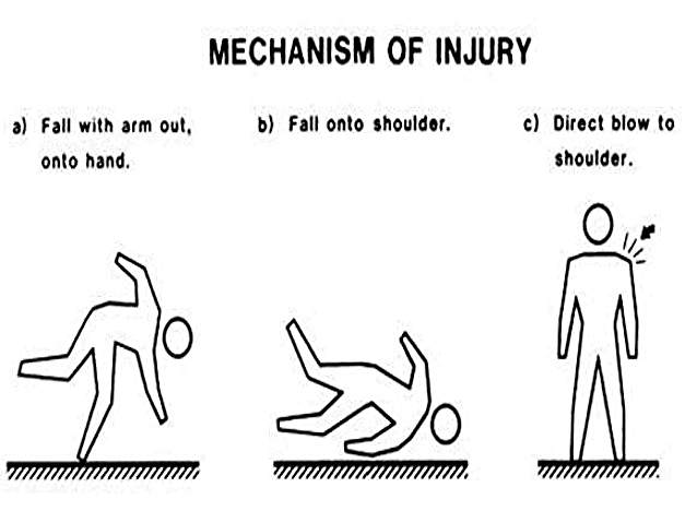 Figure 3: Common mechanisms of injury for clavicle fracture