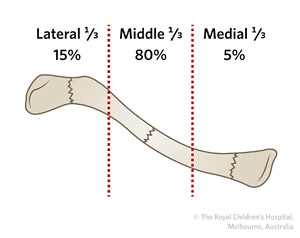 Figure 5: Proportion of clavicular fractures