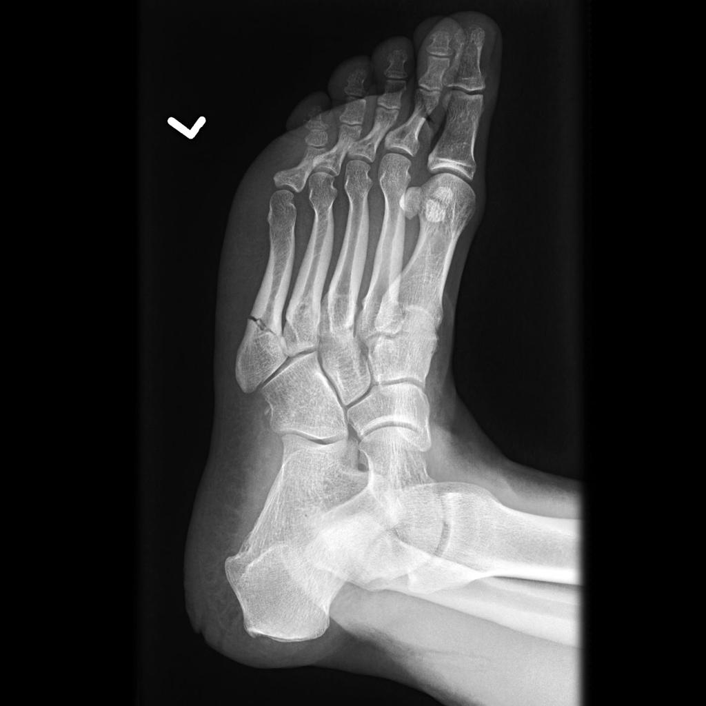 jones-fracture-4.jpg