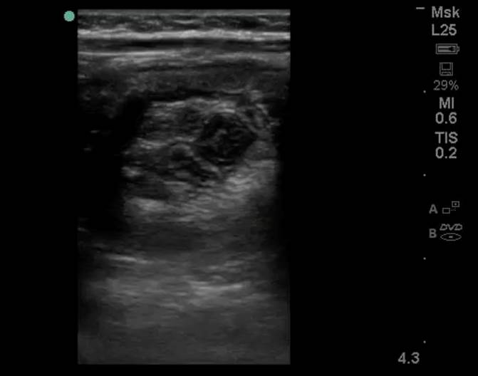 Figure 2a: Cross-sectional view of a donut-shaped mass, consistent with intussusception