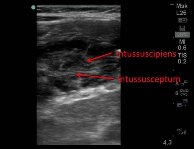 Figure 2b: Longitudinal view of the intussusception