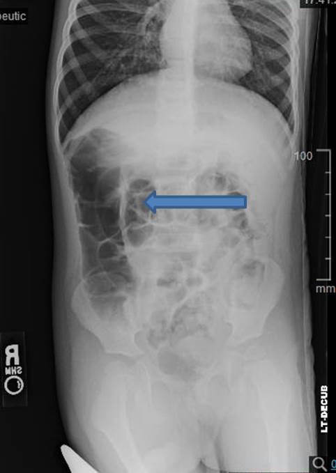 Figure 3:&nbsp;Post reduction xray