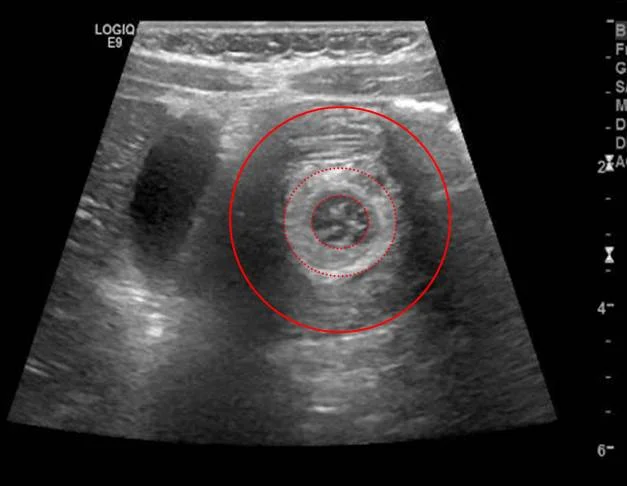 Figure 4: Cross sectional view of intussusception
