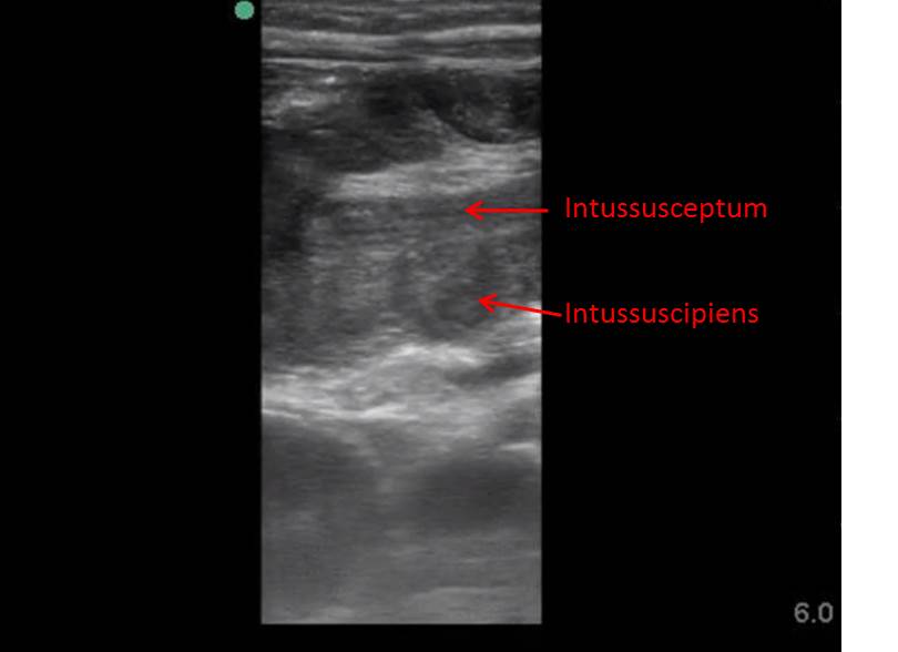 Figure 5: Longitudinal view of intussusception