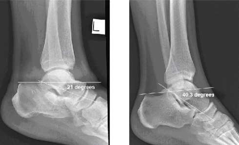 Figure 3: Bohler's angle. http://www.wikiradiography.net/page/Calcaneal+Fractures